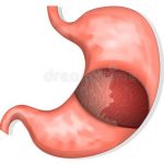 Gastritis Erosiva, Causas y Soluciones