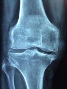 Tratamientos Alternativos para la Osteoporosis